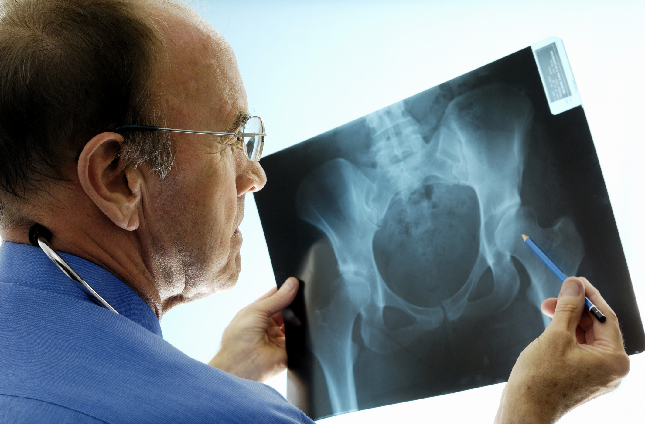 Orthopedic surgeon consulting pelvic x-rays for a hip replacement.