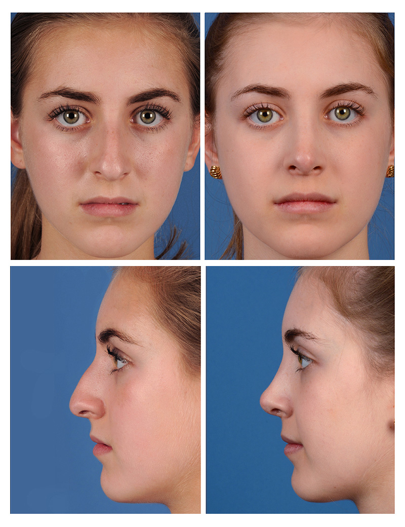 The Role of Rhinoplasty in Correcting Nasal Congenital Defects and Injuries