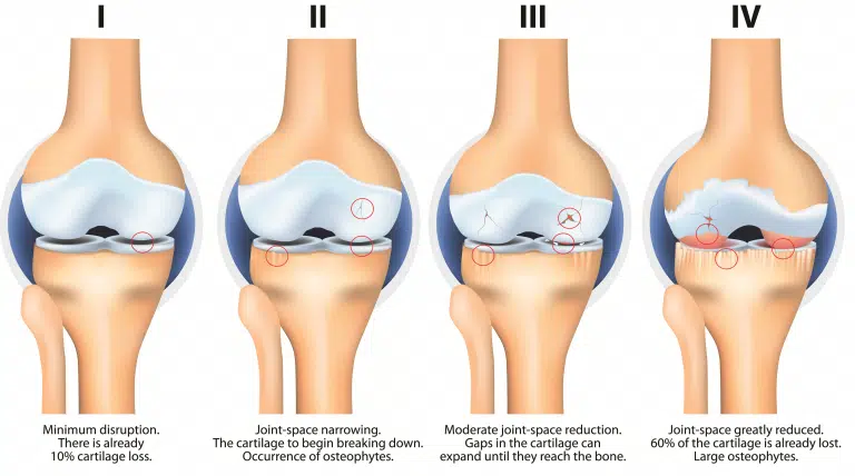 joint replacement surgery in Pakistan