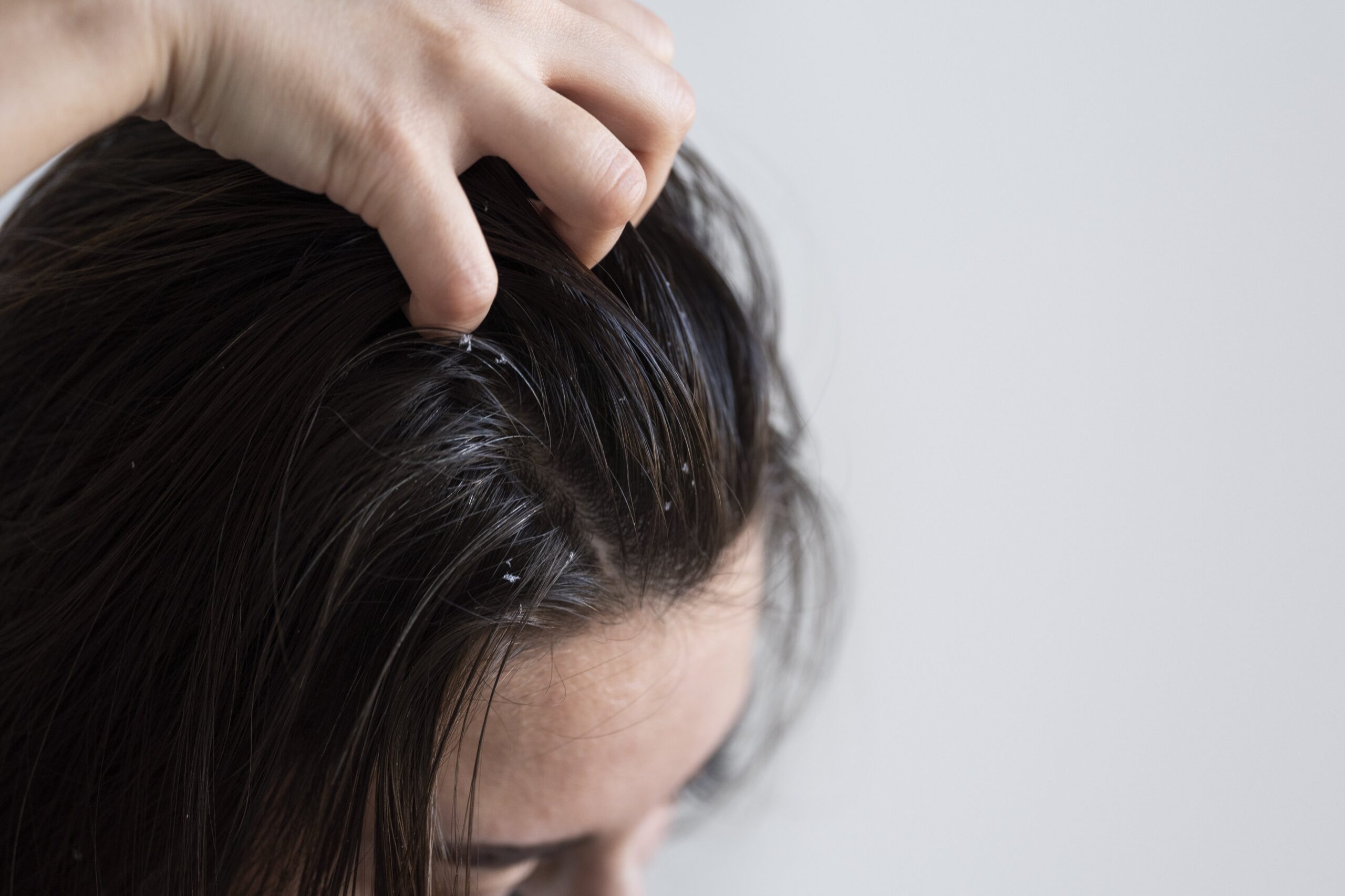 What Causes Dandruff: Understanding the Common Culprits